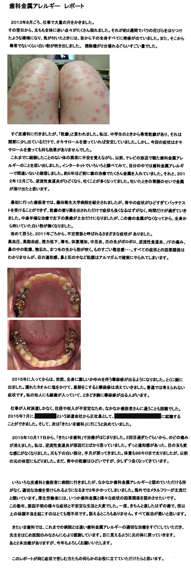 歯科金属アレルギーレポート